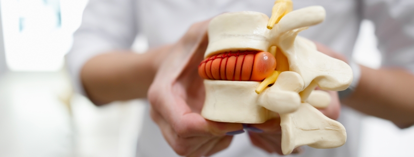 Prikaz hernije diska - stisk diska