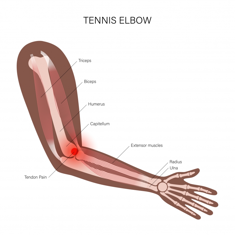 Teniški komolec - anatomija