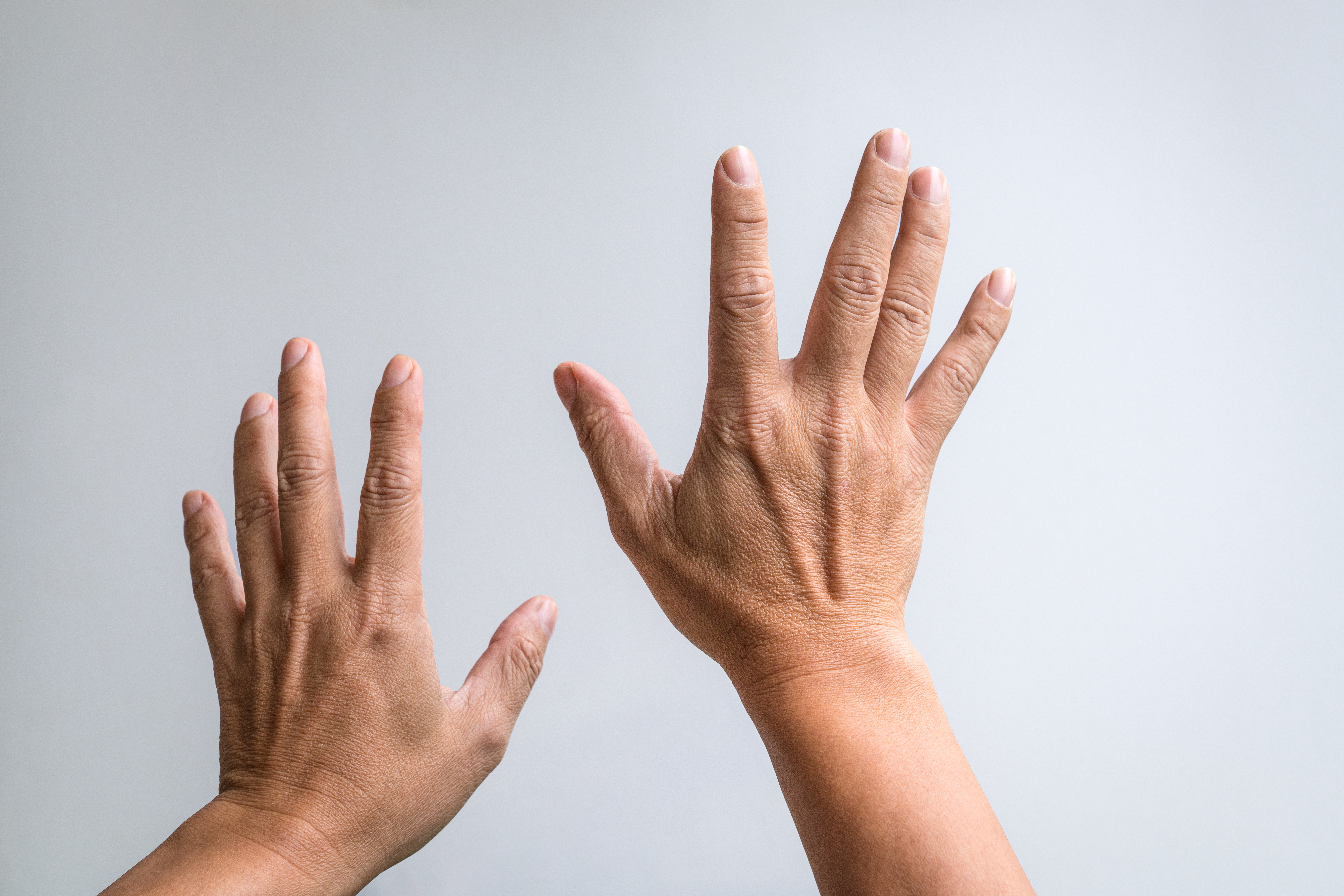 Klobasasti prsti oziroma daktilitis v sklopu artritisa